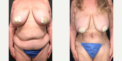 Case 339 - Woman treated with Tummy Tuck