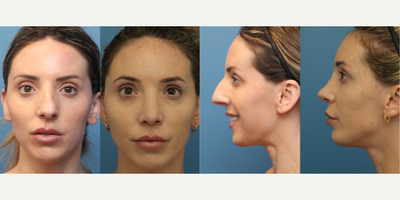 Case 3390 - 35-44 year old woman treated with Rhinoplasty