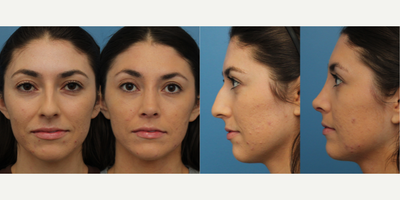 Case 3391 - 25-34 year old woman treated with Rhinoplasty