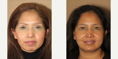 Case 3395 - Woman treated with Rhinoplasty