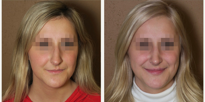 Case 3396 - Woman treated with Rhinoplasty