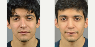 Case 3397 - Rhinoplasty