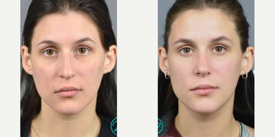 Case 3398 - Rhinoplasty