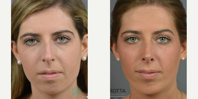 Case 3399 - Woman treated with Rhinoplasty, Septoplasty