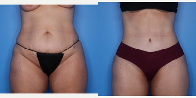 Case 34 - 35-44 year old woman treated with Tummy Tuck