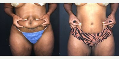 Case 340 - Woman treated with Tummy Tuck