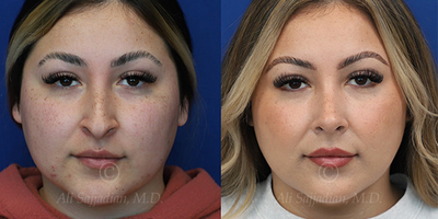 Case 3400 - Rhinoplasty