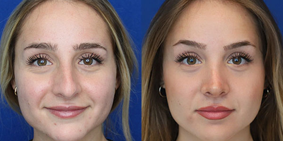 Case 3401 - Rhinoplasty