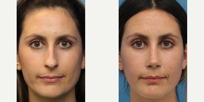 Case 3402 - Woman treated with Rhinoplasty