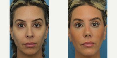 Case 3403 - Woman treated with Rhinoplasty