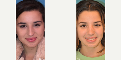 Case 3404 - Woman treated with Rhinoplasty