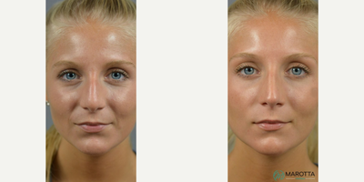 Case 3405 - Woman treated with Rhinoplasty