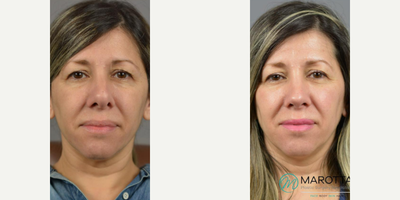 Case 3406 - Woman treated with Rhinoplasty