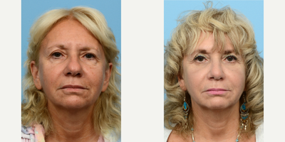 Case 3408 - 55-64 year old woman treated with Eyelid Surgery, Rhinoplasty