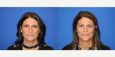 Case 3409 - Woman treated with Rhinoplasty