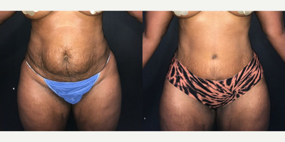 Case 341 - Woman treated with Tummy Tuck