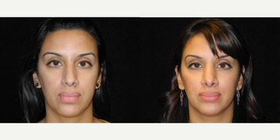 Case 3410 - Woman treated with Rhinoplasty
