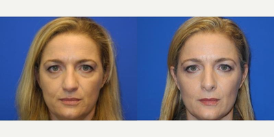 Case 3411 - Woman treated with Rhinoplasty