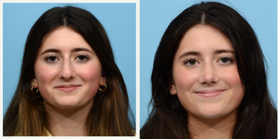 Case 3413 - 17 or under year old woman treated with Rhinoplasty