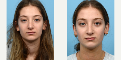 Case 3414 - 18-24 year old woman treated with Rhinoplasty