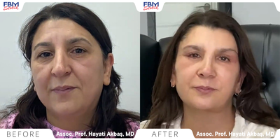 Case 3415 - 45-54 year old woman treated with Facelift, Neck Lift, Double Eyelid Surgery, Rhinoplasty, Facial Fat Transfer