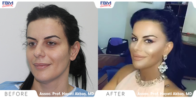 Case 3416 - 25-34 year old woman treated with Rhinoplasty