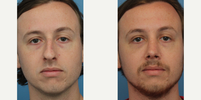 Case 3418 - Male treated with Rhinoplasty
