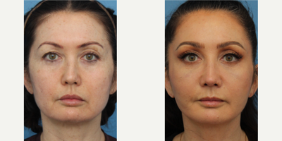 Case 3419 - Woman treated with Rhinoplasty