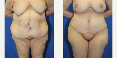 Case 342 - 55-64 year old woman treated with Tummy Tuck