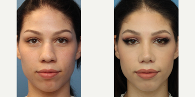Case 3420 - Woman treated with Rhinoplasty