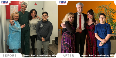 Case 3421 - 65-74 year old woman treated with Deep Plane Facelift, Neck Lift, Eyelid Surgery, Facial Fat Transfer, Rhinoplasty