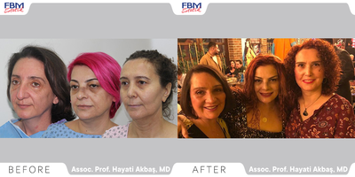 Case 3422 - 45-54 year old woman treated with Deep Plane Facelift, Neck Lift, Rhinoplasty, Facial Fat Transfer