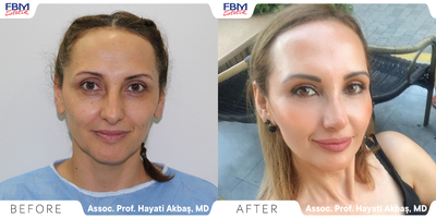Case 3423 - 35-44 year old woman treated with Facial Fat Transfer, Rhinoplasty