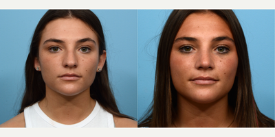 Case 3424 - 18-24 year old woman treated with Rhinoplasty
