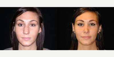 Case 3425 - Woman treated with Rhinoplasty