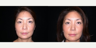 Case 3426 - Woman treated with Rhinoplasty