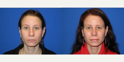 Case 3427 - Woman treated with Rhinoplasty