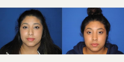 Case 3428 - Woman treated with Rhinoplasty