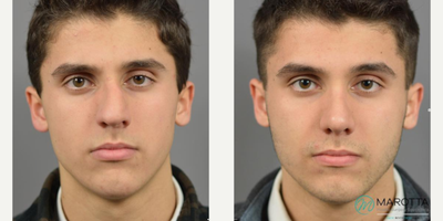 Case 3429 - Man treated with Rhinoplasty