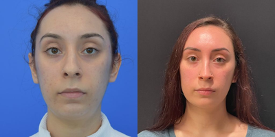 Case 3432 - Woman treated with Rhinoplasty