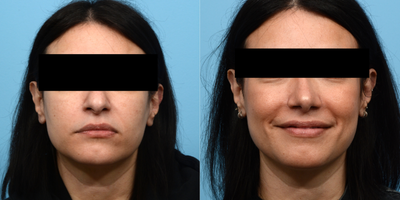 Case 3433 - 45-54 year old woman treated with Rhinoplasty