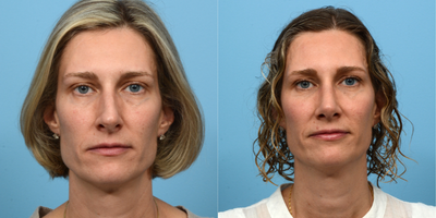 Case 3434 - 45-54 year old woman treated with Rhinoplasty