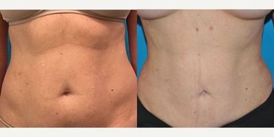 Case 3435 - Woman treated with Liposuction