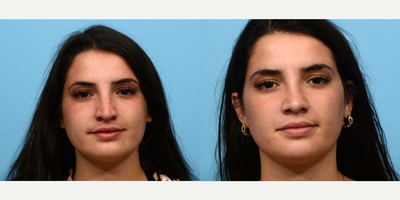 Case 3436 - 18-24 year old woman treated with Rhinoplasty