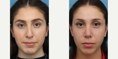 Case 3437 - Woman treated with Rhinoplasty
