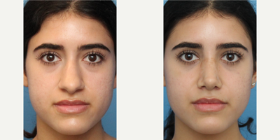 Case 3439 - Woman treated with Rhinoplasty