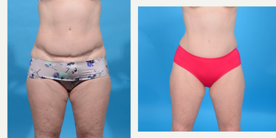 Case 344 - 45-54 year old woman treated with Tummy Tuck 