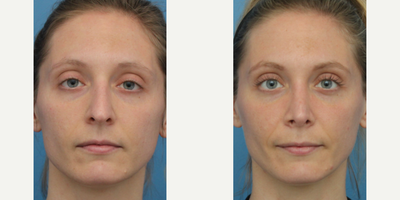 Case 3440 - Woman treated with Rhinoplasty