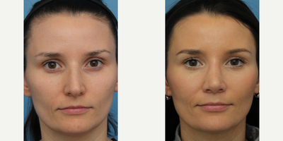 Case 3441 - Woman treated with Rhinoplasty