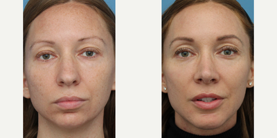 Case 3442 - Woman treated with Rhinoplasty